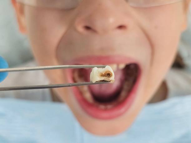 Best Urgent Care for Lost Fillings or Crowns in Oildale, CA