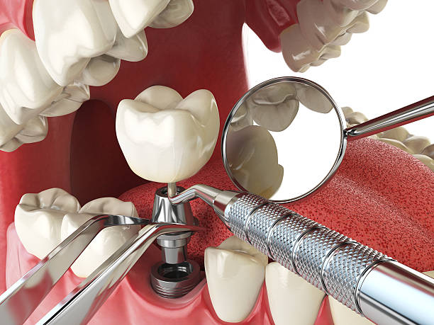 Best Emergency Tooth Extraction in Oildale, CA